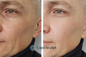 How to Fight Aging Symptoms 3 Fight Aging Symptoms Little Bognor With HIFU and Morpheus8 Today!