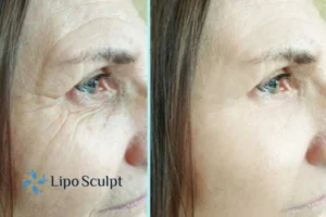 How to Fight Aging Symptoms 2 Do you want to Fight Aging Symptoms Little Bognor? Contact Lipo Sculpt today!