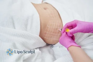 Are The Results From Aqualyx Permanent? 1 Do you want to know how long Aqualyx Little Bognor results last?