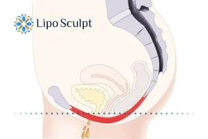 Pelvic Floor Chair Therapy 1 Pelvic Floor Chair Therapy Little Bognor to treat incontinence.