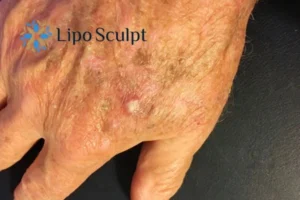 Best Actinic Keratoses Removal 2 Improve your wellbeing and health with Actinic Keratoses Little Bognor removal.treatment